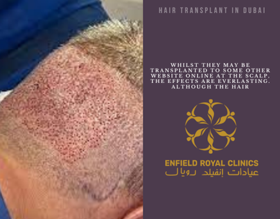 FUE Hair Transplant in Dubai UAE At Royal Clinic ?