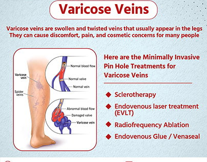 Varicose Veins- The Vascular Center