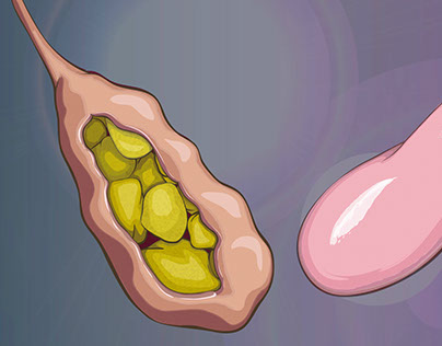 Gall Bladder, Healthy VS Unhealthy in 30 minutes