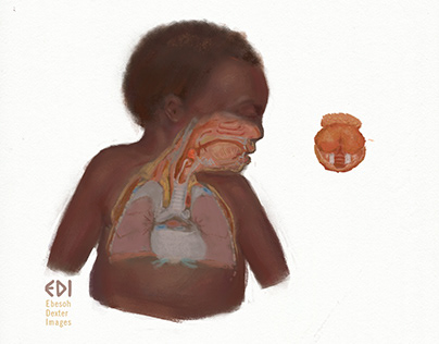 Illustration: Understanding Epiglotitis in Children