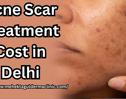Acne Scar Treatment Cost in Delhi