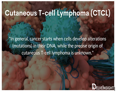 Insights Into The Cutaneous T-cell Lymphoma