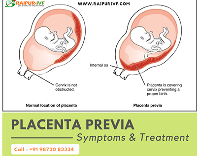 Placenta Previa-Symptoms and Treatment