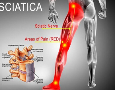 Acupuncture for sciatica is natural treatment