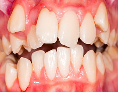 Potential Oral Health Concerns Caused by Malocclusion