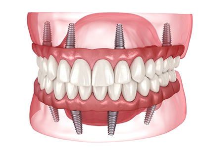 Dental implant procedure Orange CA