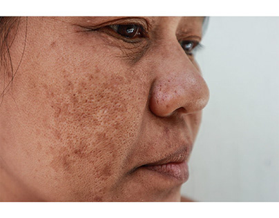 Dark Spot Treatment by Skincare Specialists | MiamiMD