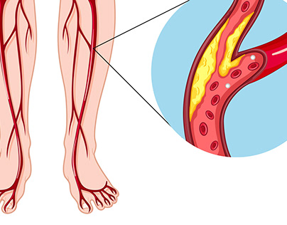 Peripheral Artery Disease - Symptoms And Causes