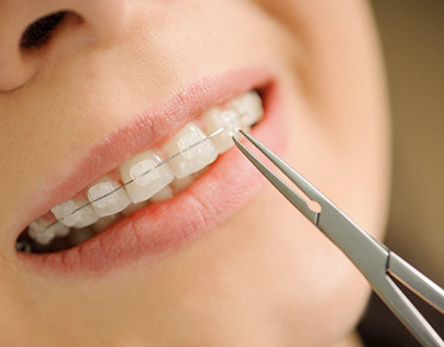 How Old Should You Be To Get Dental Braces?