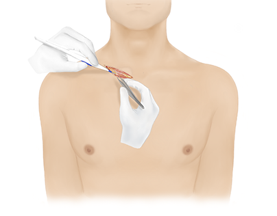 Management of sternoclavicular dislocation