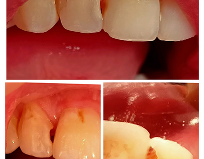 class III composite restoration M&D for upper lateral
