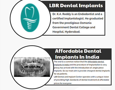 Most Affordable Dental Implants in India