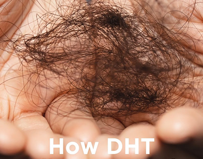 How DHT influences Hair Loss
