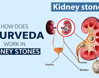 How does Ayurveda works in Kidney Stones