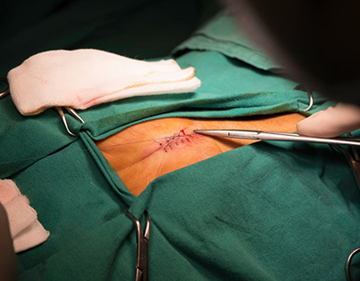 Open Heart Surgery Scar