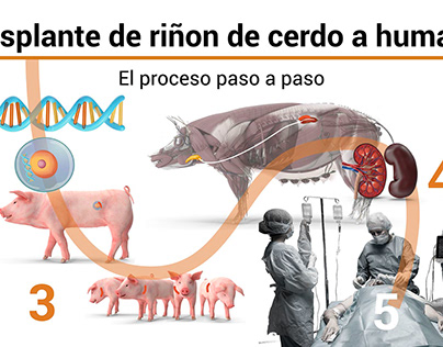 Transplante de riñón de cerdo a humano