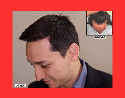 Revitalize Your Look Best Hair Transplant South Africa