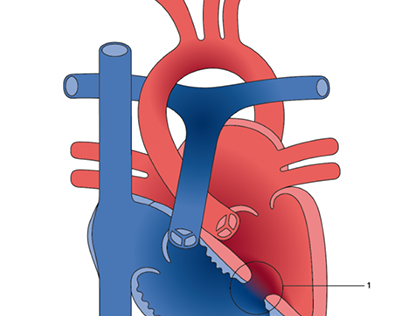 Plan Your Ventricular Septal Defect Surgery In India