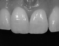 Midline Correction with a Single Central Incisor