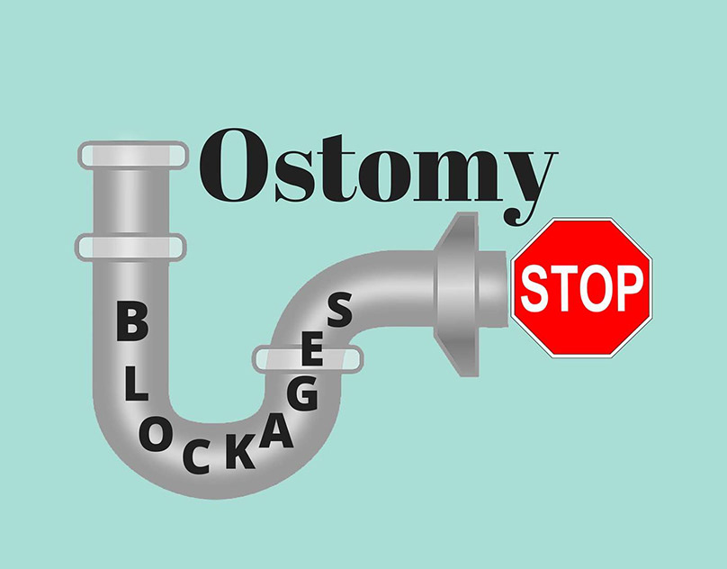 Food Related Ostomy Issues.