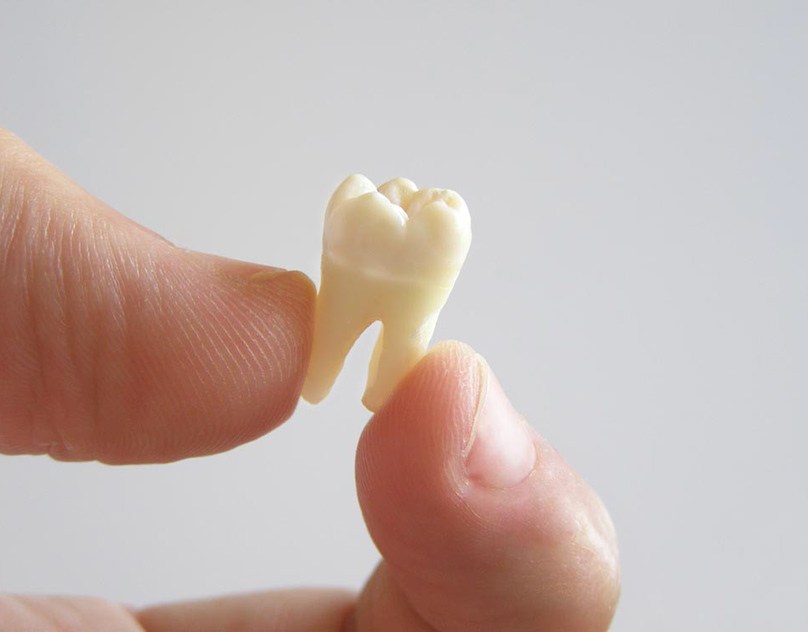 A Wound in a Child`s Mouth without One Tooth is Close-up. the Girl Just Pulled O